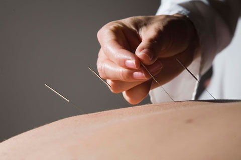 Acupuncture1